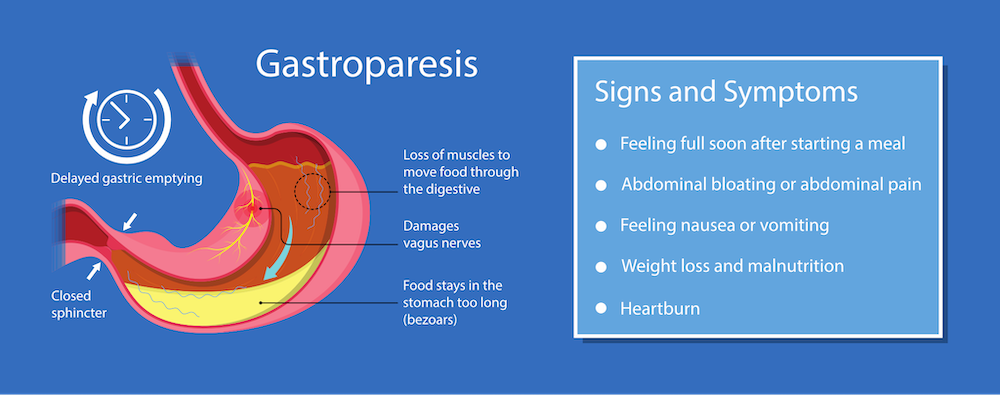 Gastroparesis