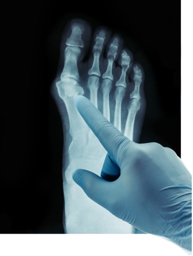 Foot X-Ray