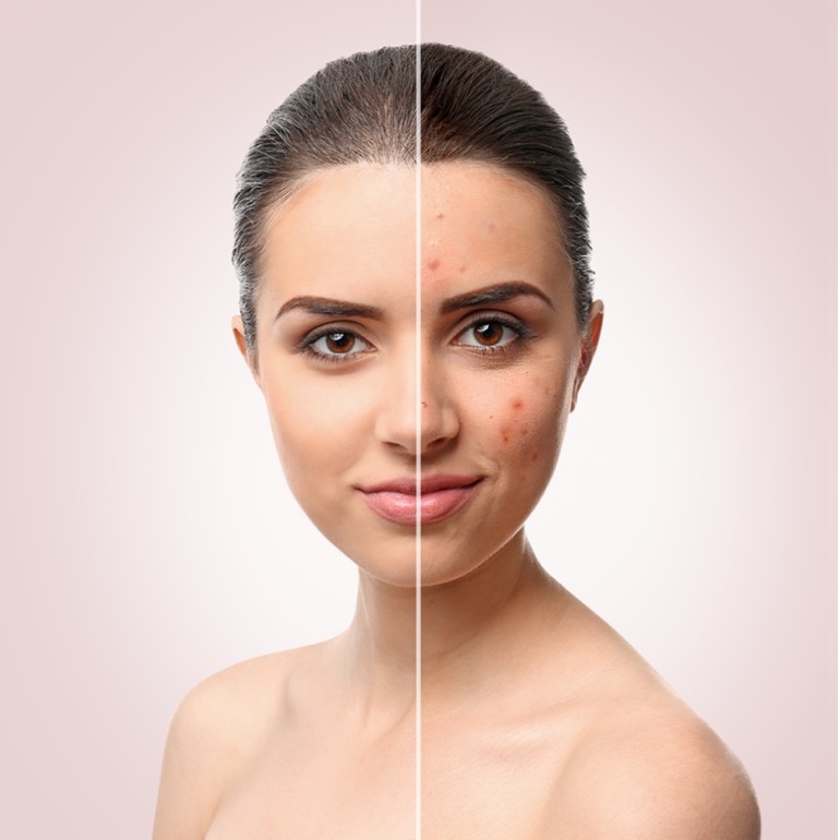 Comparison of a girl with and without acne