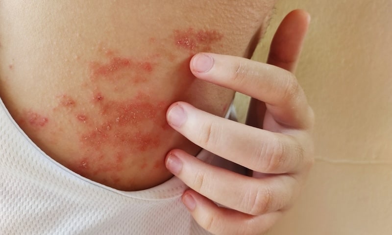 Atopic Dermatitis—Eczema