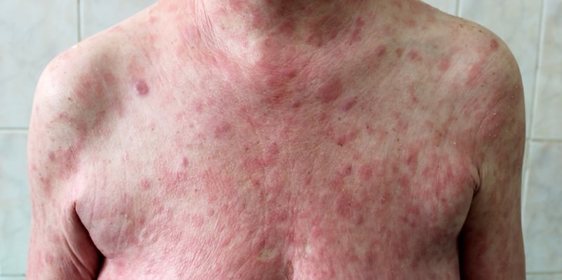 Cutaneous T-Cell Lymphoma (CTCL)