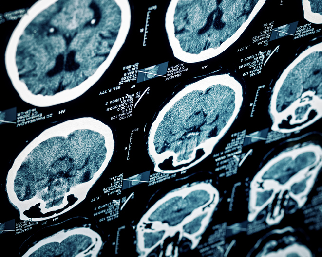 mri of brain